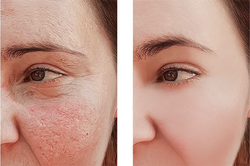 Comparison of skin texture enhancement before and after laser resurfacing.