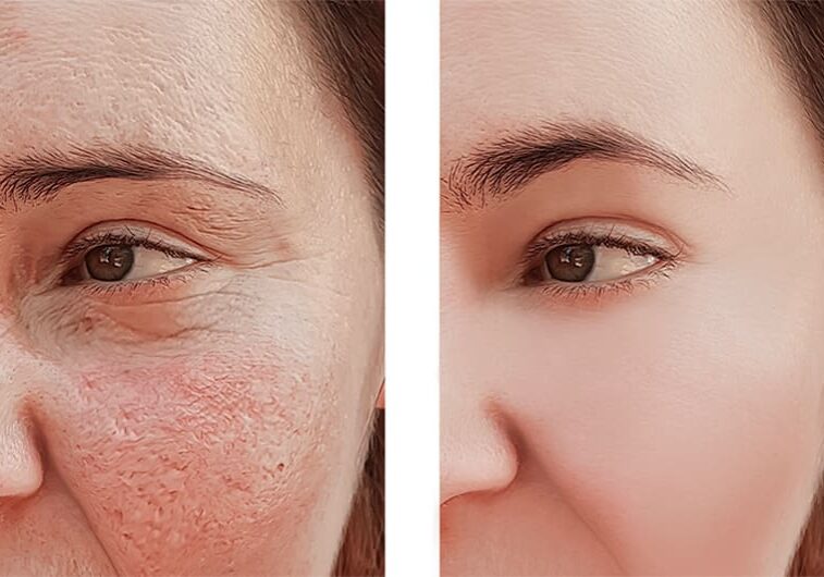 Comparison of skin texture enhancement before and after laser resurfacing.